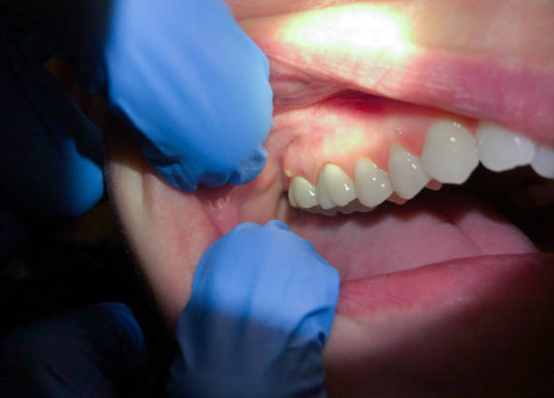 Best Emergency Wisdom Teeth Removal in Joseph, OR